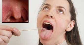 Những điều cần biết về bệnh viêm họng hạt mãn tính và cách điều trị