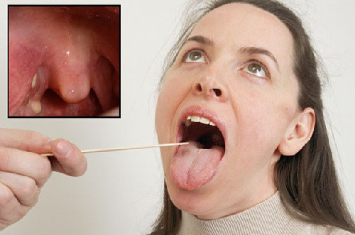 Những điều cần biết về bệnh viêm họng hạt mãn tính và cách điều trị
