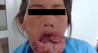 Phẫu thuật thành công cho người bệnh ung thư môi dưới lan rộng