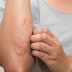 Phương pháp điều trị viêm da cơ địa mạn tính