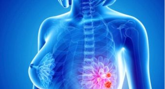 Thống kê 5 loại bệnh ung thư phụ nữ dễ mắc phải
