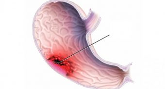 Thống kê các nguyên nhân mắc ung thư dạ dày