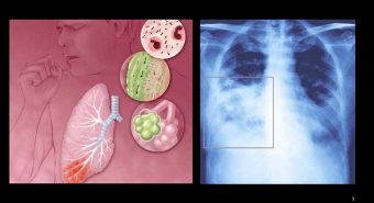 Vi khuẩn Legionella gây viêm phổi cấp bùng phát tại Mỹ