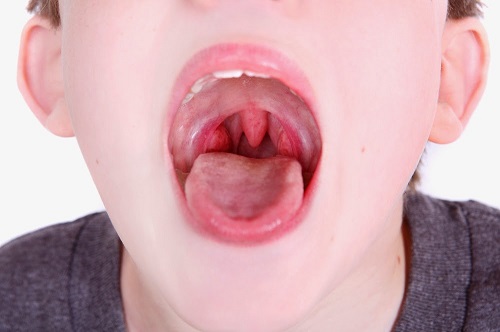 Rất nhiều trẻ em bị viêm amidan