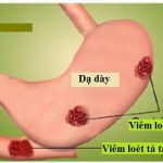 Viêm loét dạ dày là nguyên nhân chính gây ung thư dạ dày