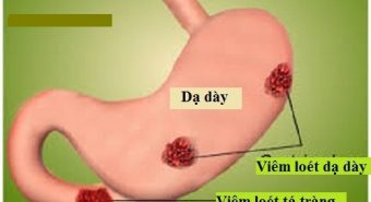 Viêm loét dạ dày là nguyên nhân chính gây ung thư dạ dày