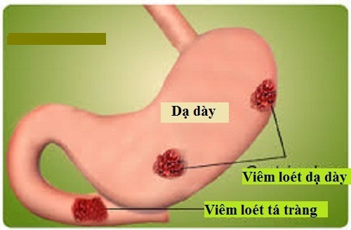 Viêm loét dạ dày là nguyên nhân gây ung thư dạ dày