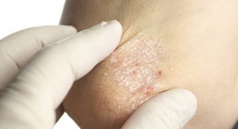 Phải xử lý như thế nào khi bị ngứa do bệnh vảy nến?