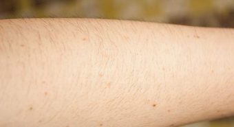 Báo động nốt ruồi trên cánh tay tỷ lệ thuận với nguy cơ ung thư da