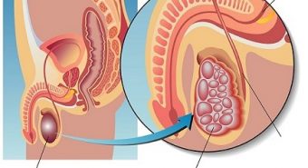 Ung thư tinh hoàn có những dấu hiệu cảnh báo nào?