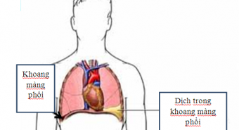 Tư thế nằm cho bệnh nhân tràn dịch màng phổi