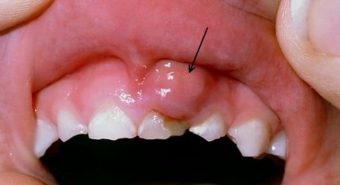 8 triệu chứng ung thư miệng cần chú ý