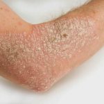 Nhiễm trùng, nhiễm khuẩn, nấm có thể làm bệnh vảy nến nặng hơn