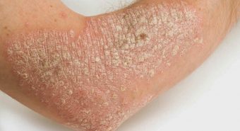 Nhiễm trùng, nhiễm khuẩn, nấm có thể làm bệnh vảy nến nặng hơn