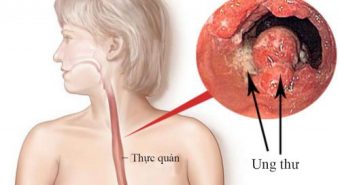 Bệnh trào ngược dạ dày - những điều cần lưu tâm