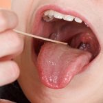 Bệnh ung thư lưỡi phát triển qua mấy giai đoạn?