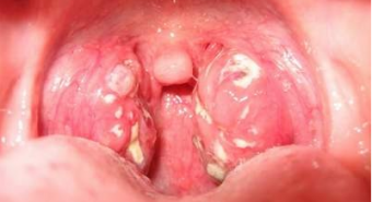 Bệnh viêm họng hạt có khó điều trị không?