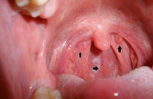 Bệnh viêm họng hạt