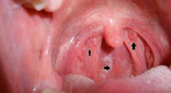 Một số cách nhận biết bệnh viêm họng hạt