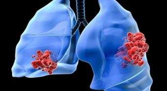 Cách đếm nhịp thở phát hiện bệnh viêm phổi