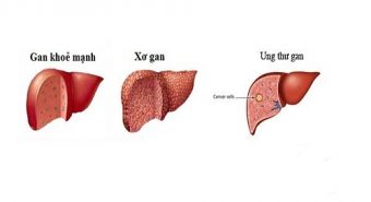 Ung thư gan - Biến chứng của bệnh xơ gan khi điều trị muộn