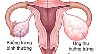 “Chân dài” dễ mắc bệnh ung thư buồng trứng
