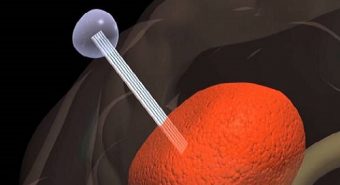 Kỹ thuật điều trị u não mới với “cần câu” đặc biệt