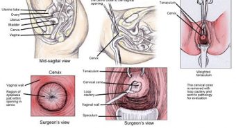 Bị bệnh viêm lộ tuyến cổ tử cung nhưng lỡ quan hệ thì có làm sao không?