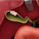 Dấu hiệu âm thầm báo hiệu bệnh ung thư túi mật