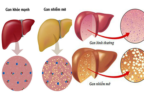 Gan nhiễm mỡ là dấu hiệu nhiều bệnh lí nguy hiểm