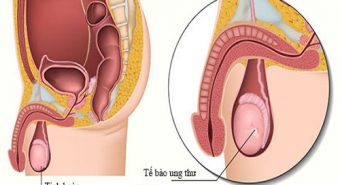 Phát hiện ung thư tinh hoàn khi đi khám vô sinh