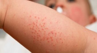 Sốt xuất huyết ở trẻ em – Đề phòng các biến chứng khó lường