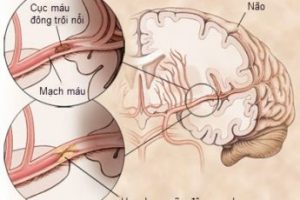 Bệnh thiếu máu não