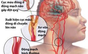 Cách phòng ngừa cơn thiếu máu não thoáng qua