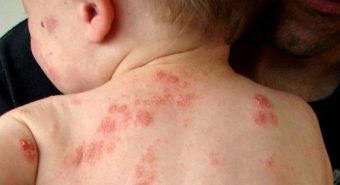 Bệnh viêm da cơ địa  dị ứng