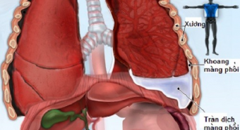 Bị tràn dịch màng phổi do gãy xương sườn