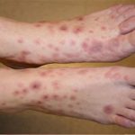 Bị ung thư da ở những vị trí không ngờ tới