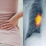 Triệu chứng đau nhức trong ung thư xương di căn