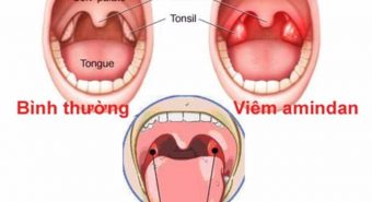 Dấu hiệu của bệnh viêm amidan?