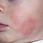 Triệu chứng của bệnh viêm da cơ địa