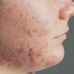 Bệnh viêm da cơ địa có điều trị khỏi không?