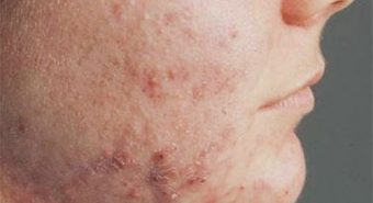 Bệnh viêm da cơ địa có điều trị khỏi không?