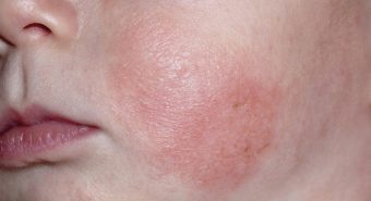 Triệu chứng của bệnh viêm da cơ địa