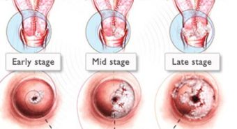 Ðiều trị bệnh viêm lộ tuyến cổ tử cung