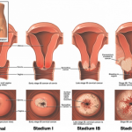 Phương pháp chữa viêm lộ tuyến không cần đốt laser