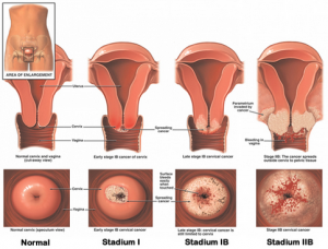 viêm lộ tuyến cổ tử cung